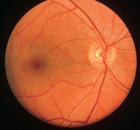 Astra Zeneca. Retina normal
