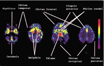 Im�genes cerebrales con PET