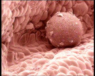 Recreacion de una imagen tumoral. Imagen de sciencepics.org con licencia Creative Commons 