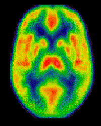 Tomografia de positrones