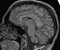 resonancia magn�tica del cerebro