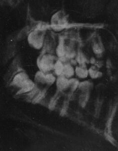 Rx simple de una boca