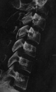 Rx simple de v�rtebras cervicales