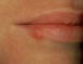 herpes labial